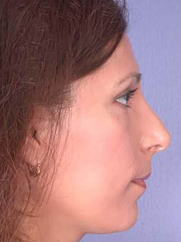 Rhinoplasty Before & After Image