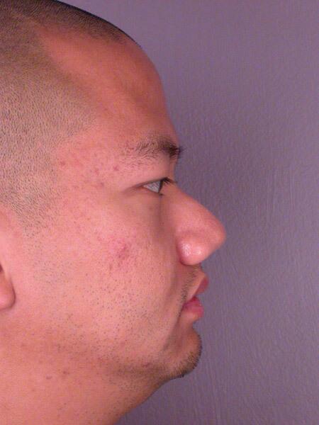 Rhinoplasty Before & After Image