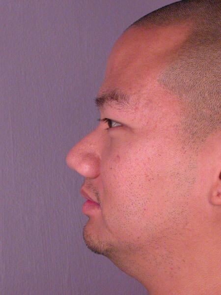 Rhinoplasty Before & After Image