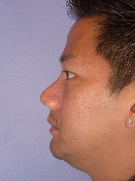 Rhinoplasty Before & After Image