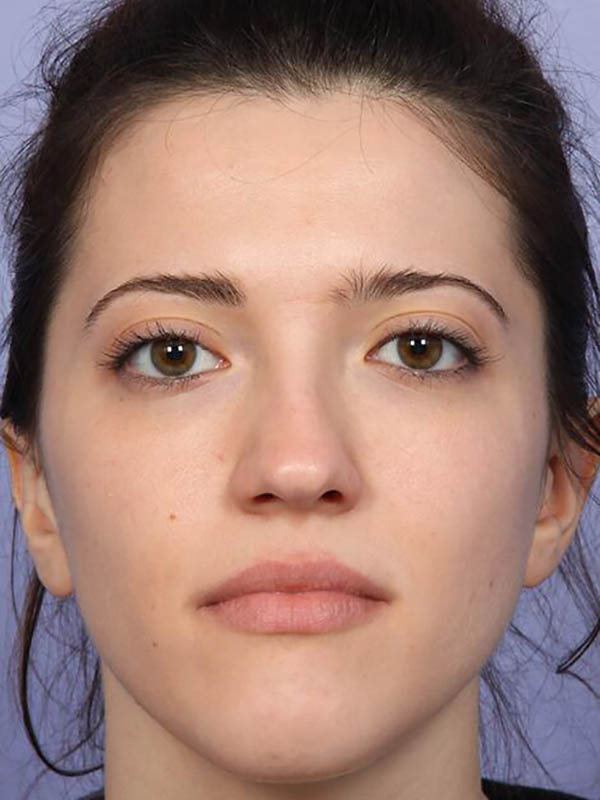 Rhinoplasty Before & After Image