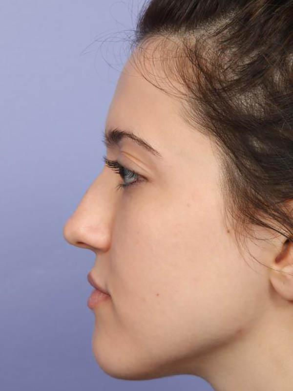 Rhinoplasty Before & After Image