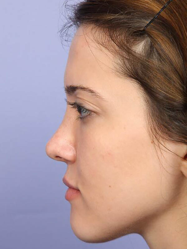 Rhinoplasty Before & After Image