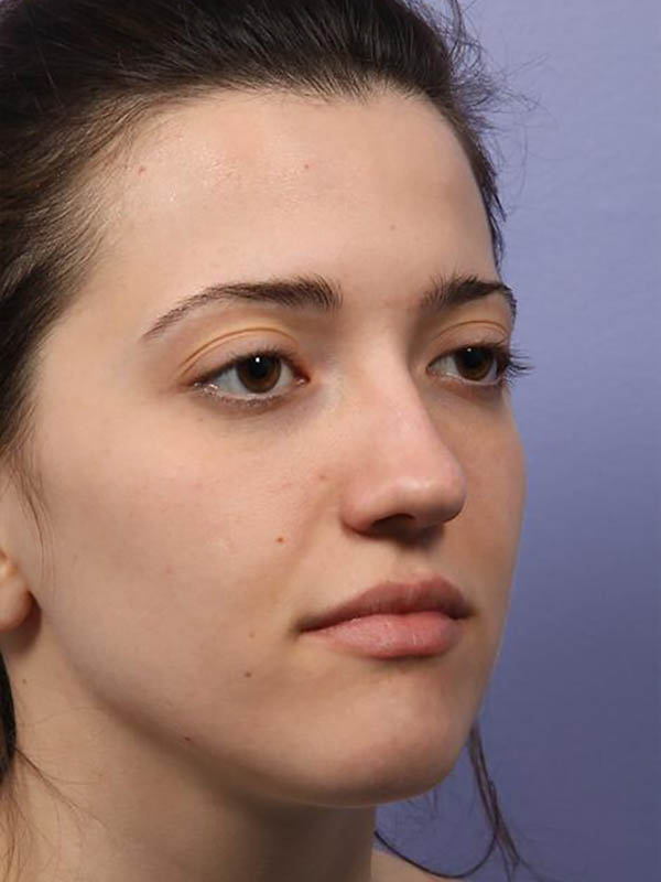 Rhinoplasty Before & After Image