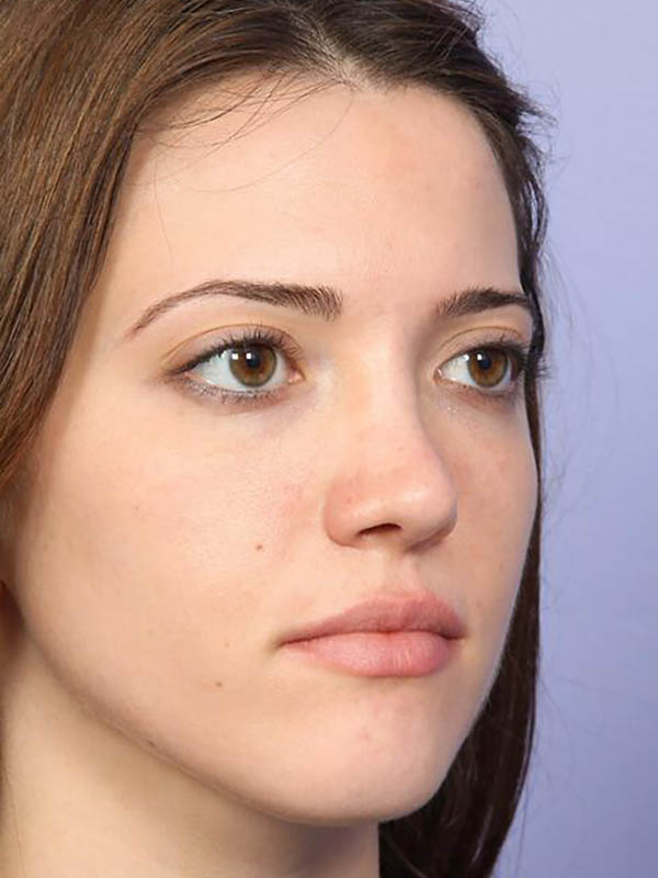 Rhinoplasty Before & After Image