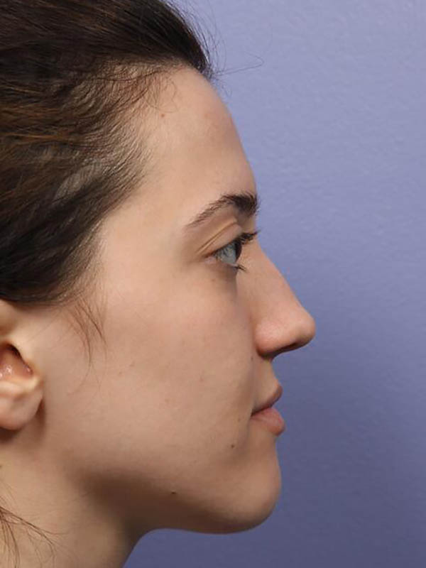 Rhinoplasty Before & After Image