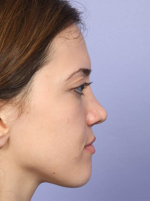 Rhinoplasty Before & After Image