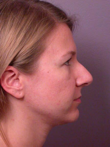 Rhinoplasty Before & After Image