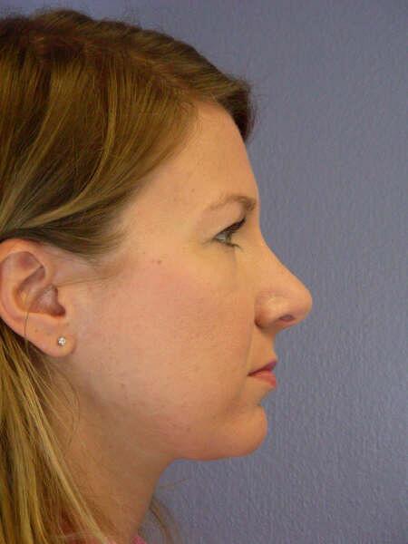 Rhinoplasty Before & After Image