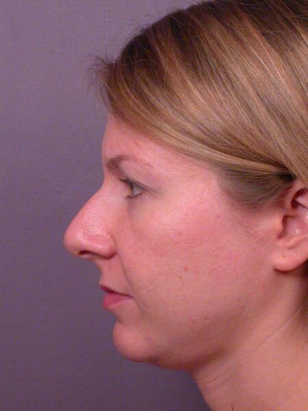 Rhinoplasty Before & After Image