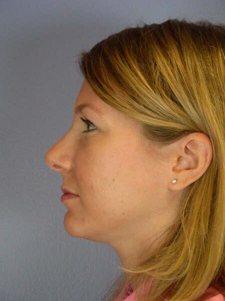 Rhinoplasty Before & After Image