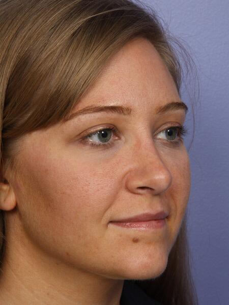 Rhinoplasty Before & After Image