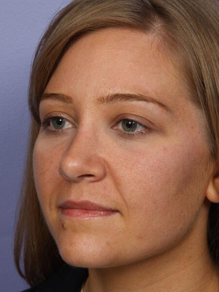 Rhinoplasty Before & After Image