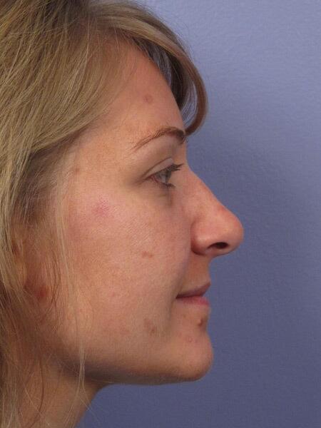 Rhinoplasty Before & After Image