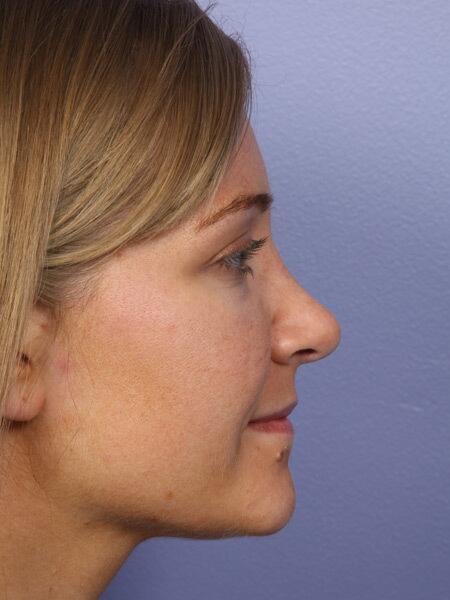 Rhinoplasty Before & After Image