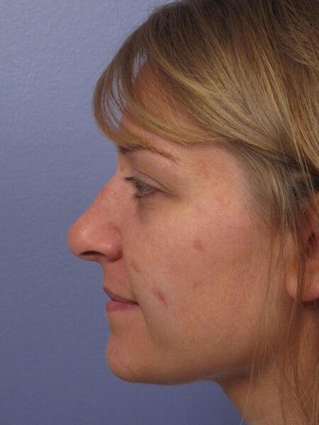 Rhinoplasty Before & After Image