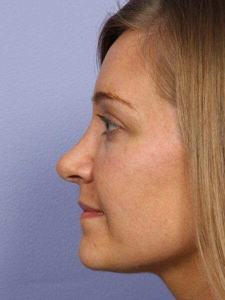 Rhinoplasty Before & After Image