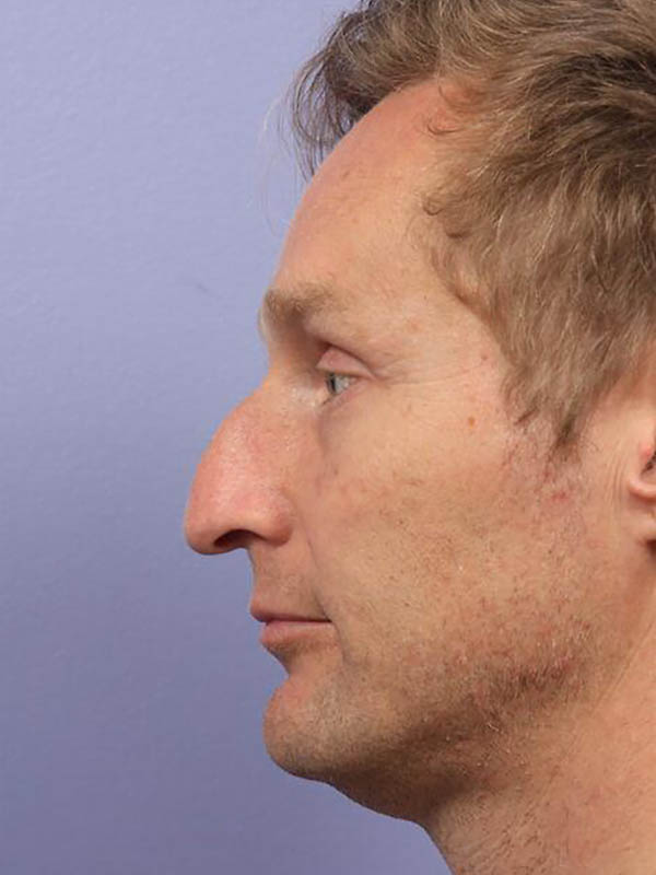 Rhinoplasty Before & After Image