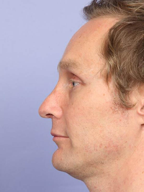 Rhinoplasty Before & After Image