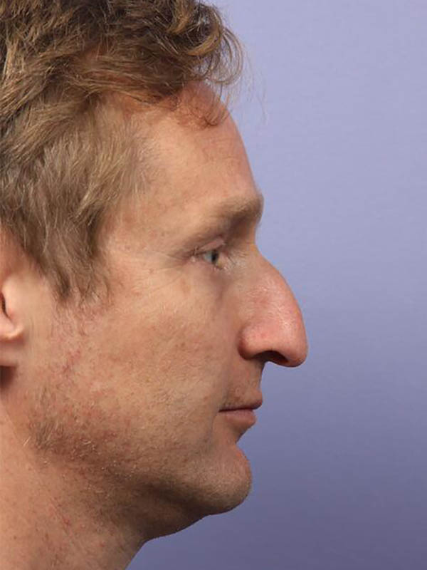 Rhinoplasty Before & After Image