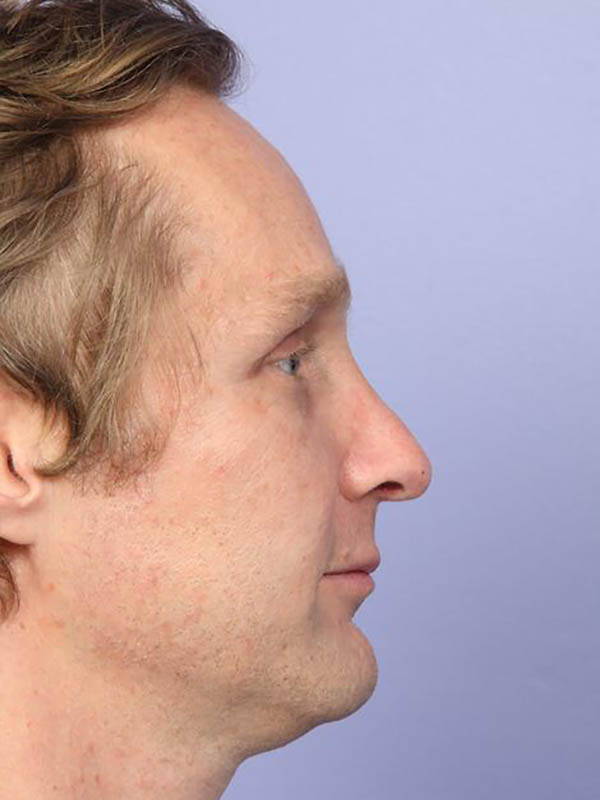 Rhinoplasty Before & After Image