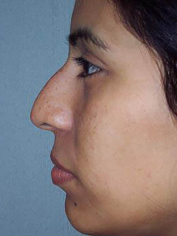 Rhinoplasty Before & After Image