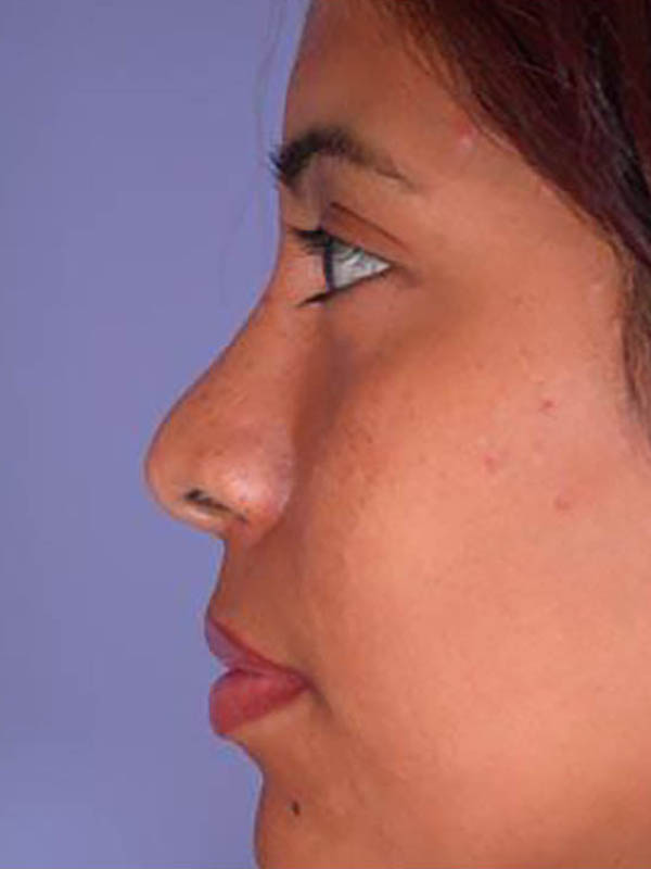 Rhinoplasty Before & After Image