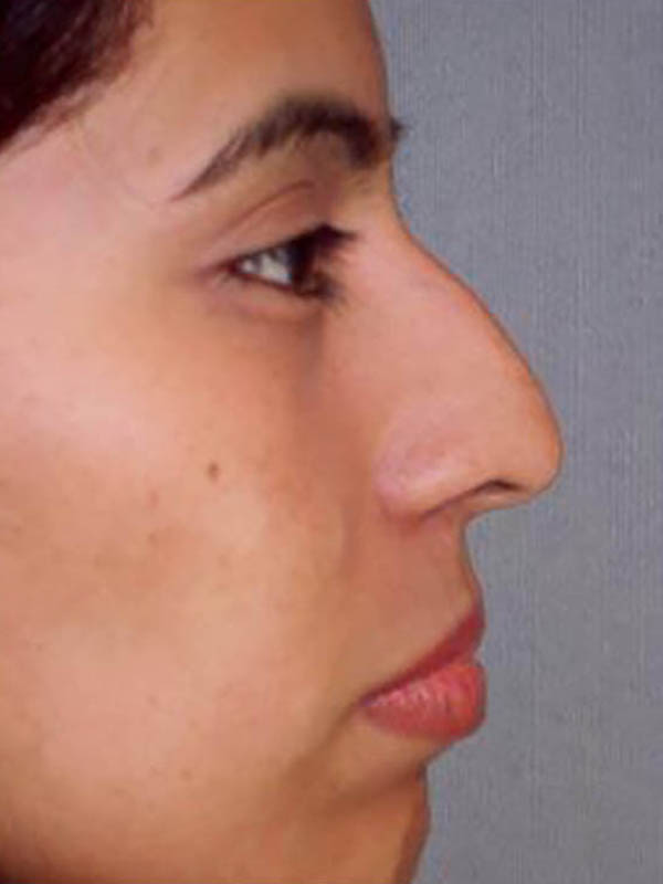 Rhinoplasty Before & After Image