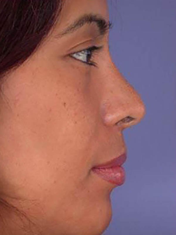 Rhinoplasty Before & After Image