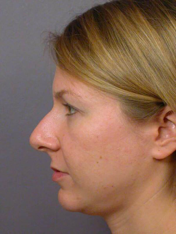 Rhinoplasty Before & After Image