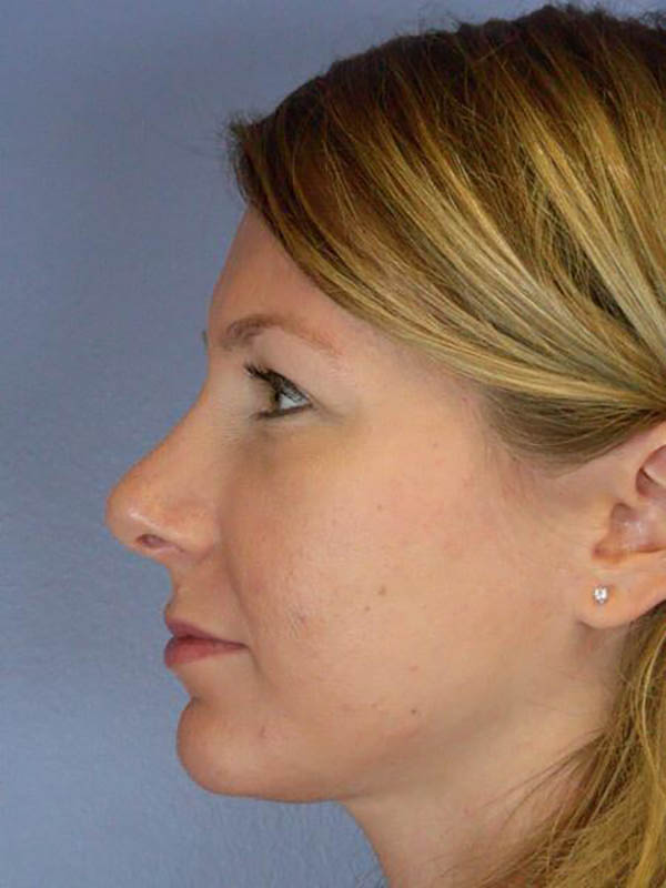 Rhinoplasty Before & After Image