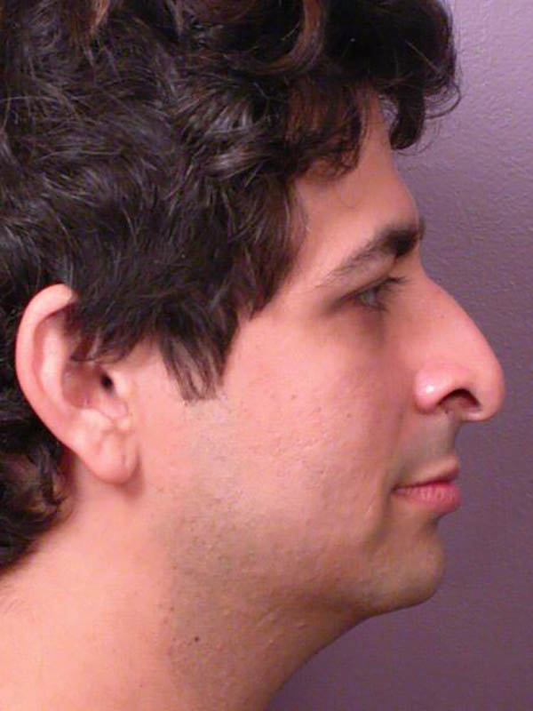 Rhinoplasty Before & After Image