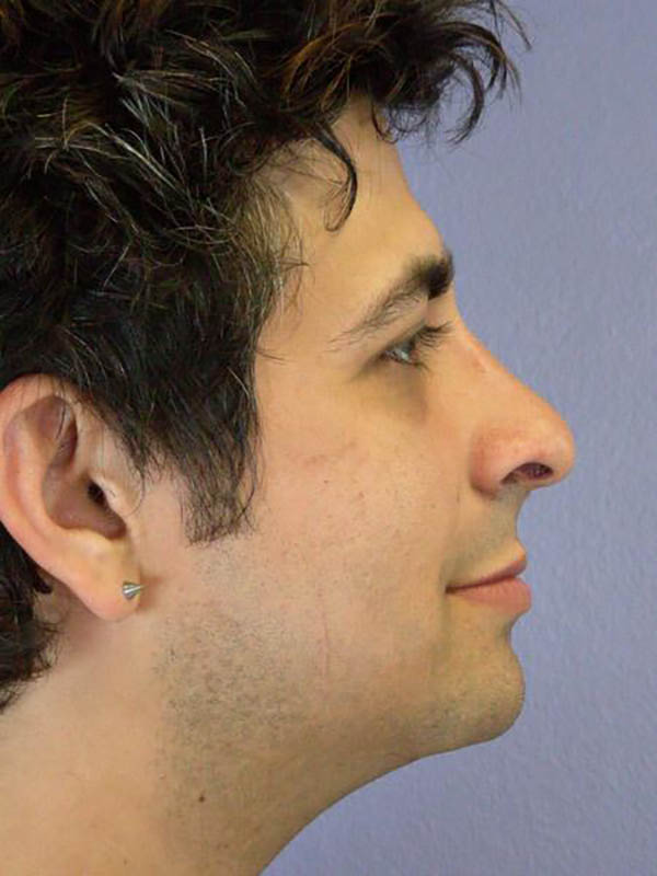 Rhinoplasty Before & After Image