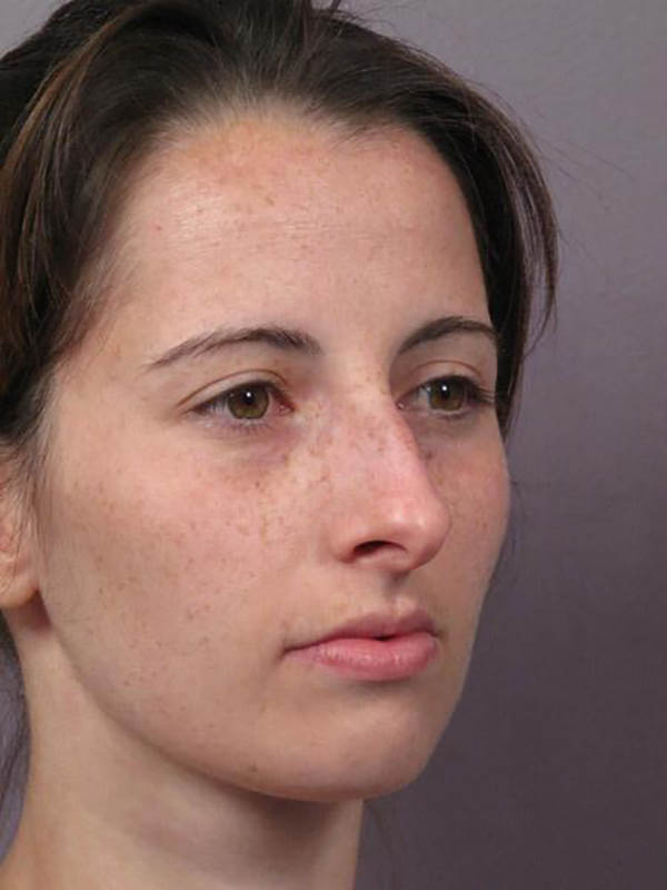 Rhinoplasty Before & After Image