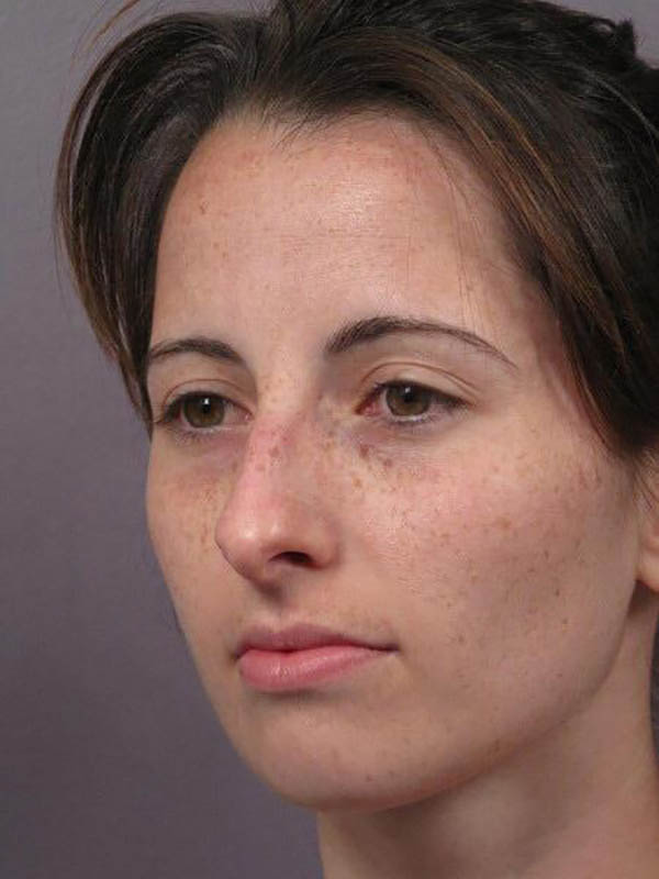 Rhinoplasty Before & After Image