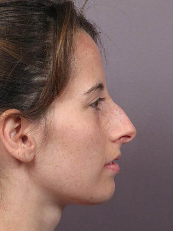 Rhinoplasty Before & After Image