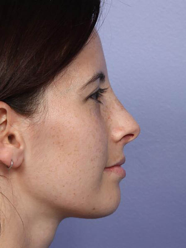 Rhinoplasty Before & After Image