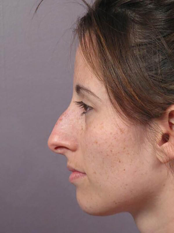 Rhinoplasty Before & After Image