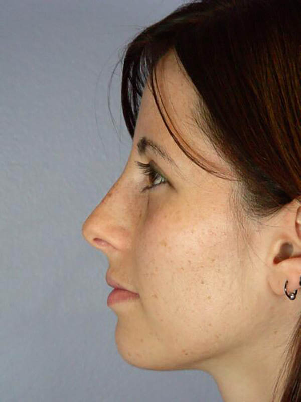 Rhinoplasty Before & After Image