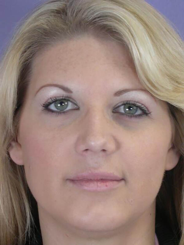 Rhinoplasty Before & After Image