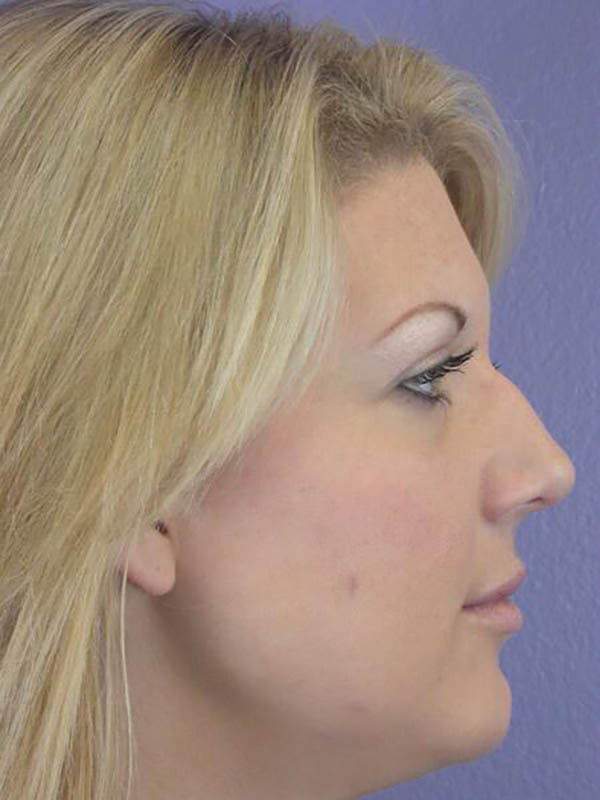 Rhinoplasty Before & After Image