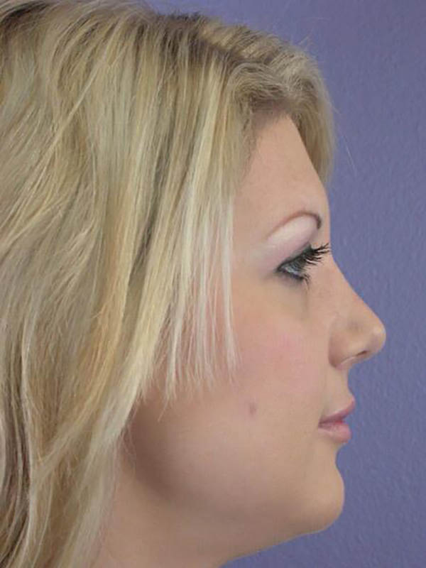 Rhinoplasty Before & After Image