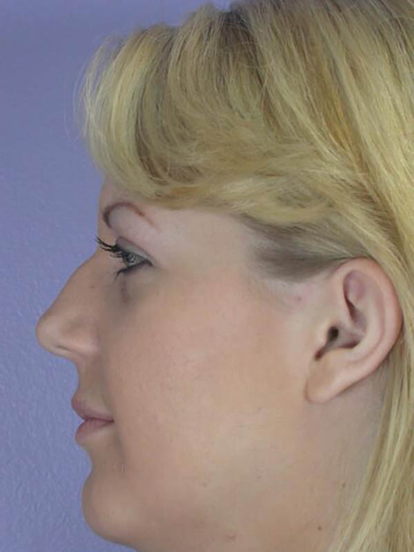 Rhinoplasty Before & After Image