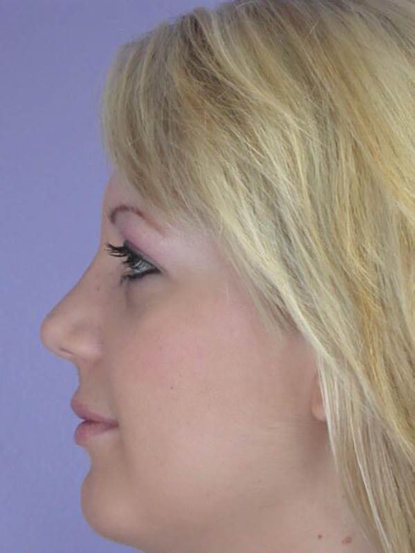 Rhinoplasty Before & After Image