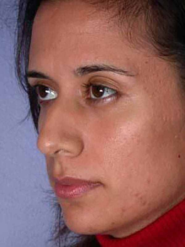 Rhinoplasty Before & After Image