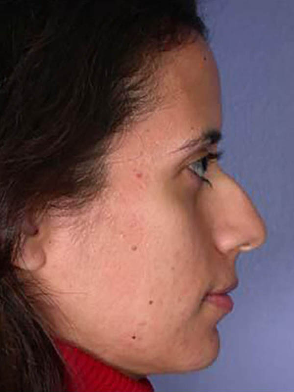 Rhinoplasty Before & After Image