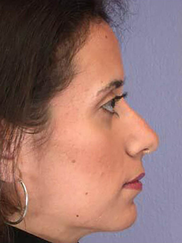 Rhinoplasty Before & After Image