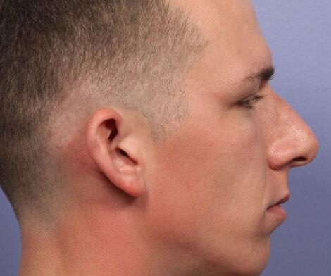 Rhinoplasty Before & After Image