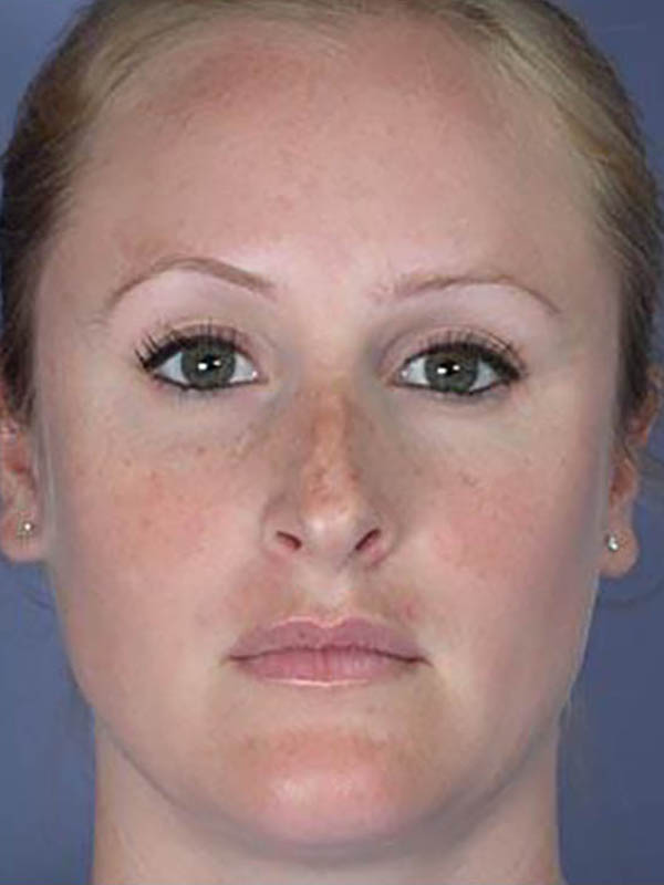 Rhinoplasty Before & After Image