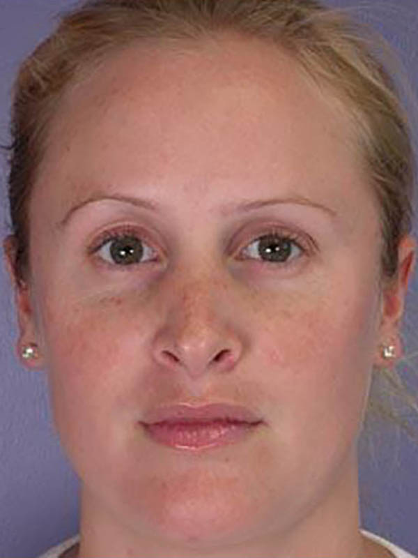 Rhinoplasty Before & After Image